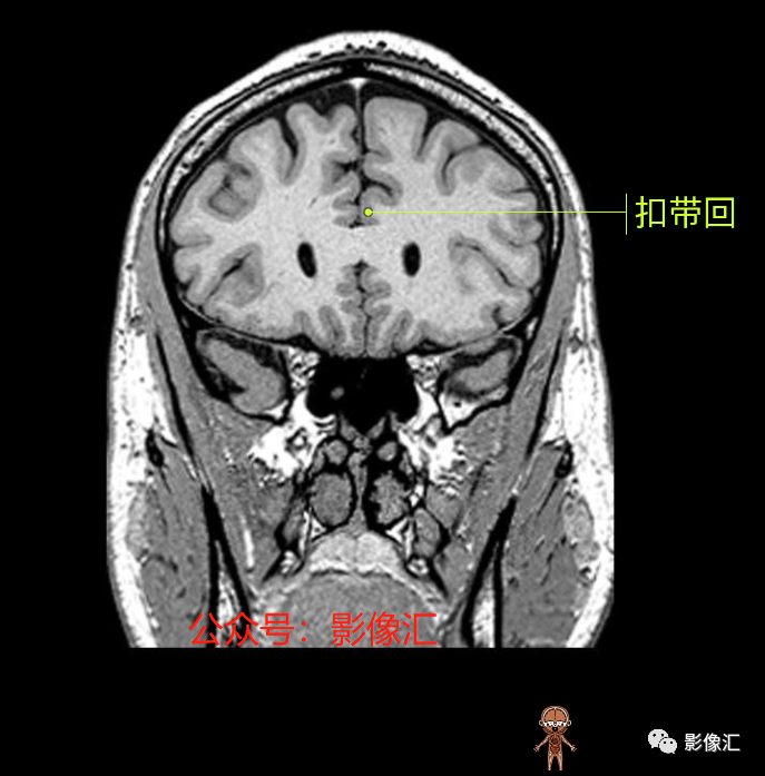 影像PPT - 脑边缘叶MR解剖标记-87