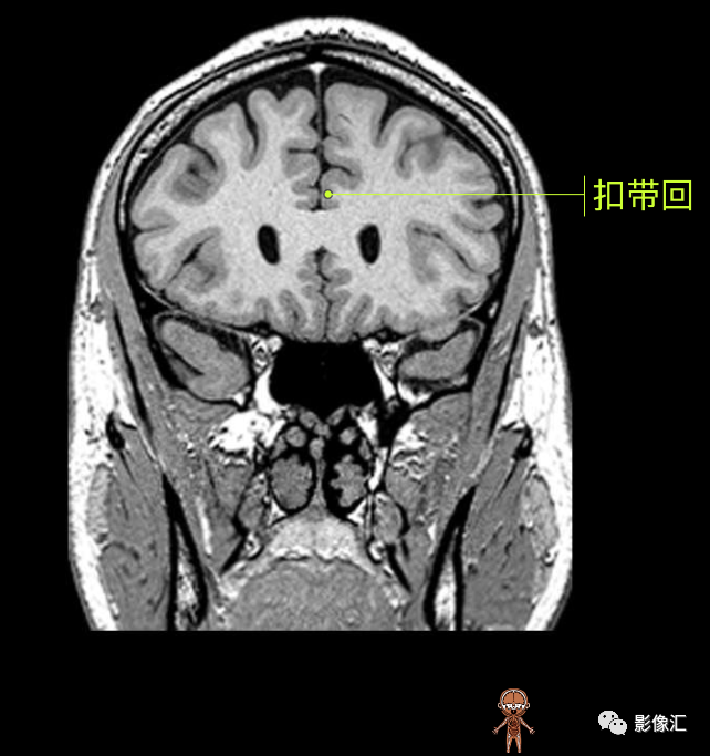 影像PPT - 脑边缘叶MR解剖标记-88