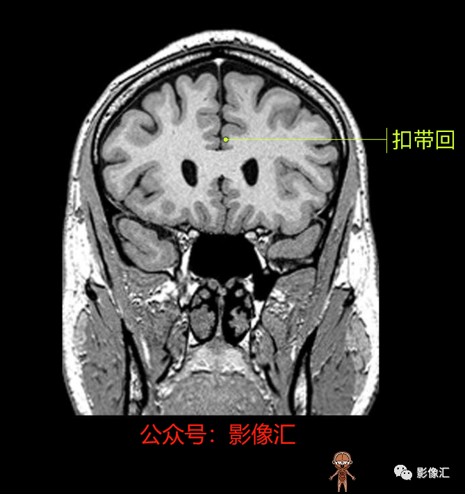 影像PPT - 脑边缘叶MR解剖标记-89