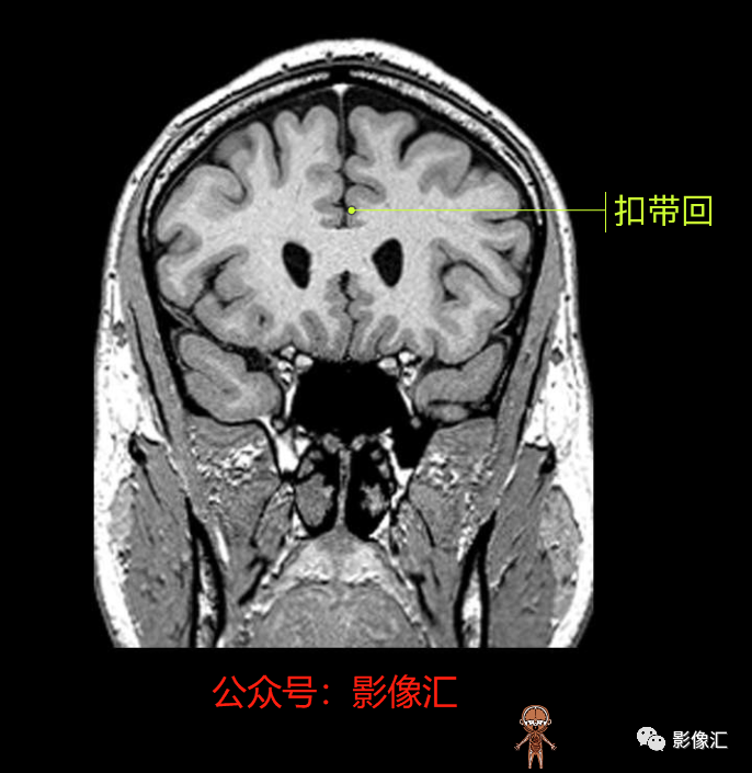 影像PPT - 脑边缘叶MR解剖标记-90