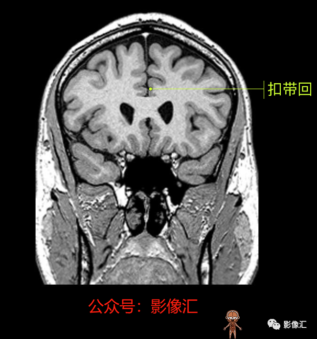 影像PPT - 脑边缘叶MR解剖标记-91