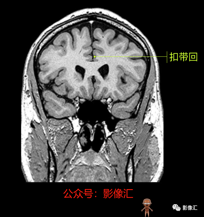 影像PPT - 脑边缘叶MR解剖标记-92