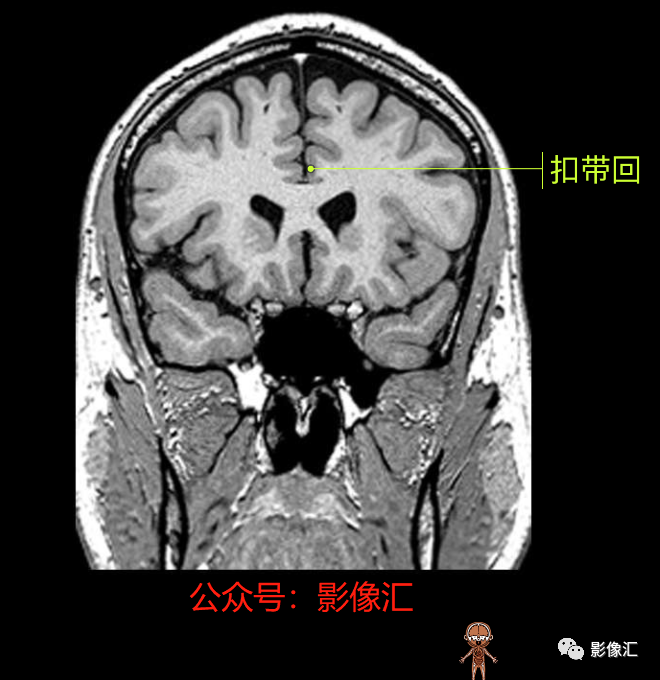 影像PPT - 脑边缘叶MR解剖标记-93