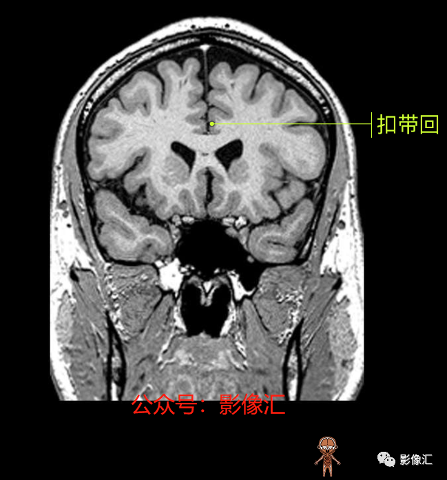 影像PPT - 脑边缘叶MR解剖标记-94