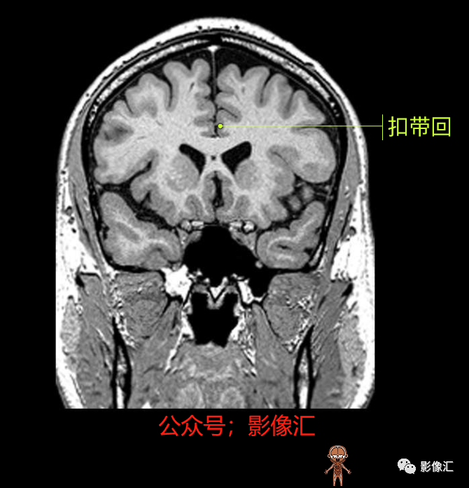 影像PPT - 脑边缘叶MR解剖标记-95