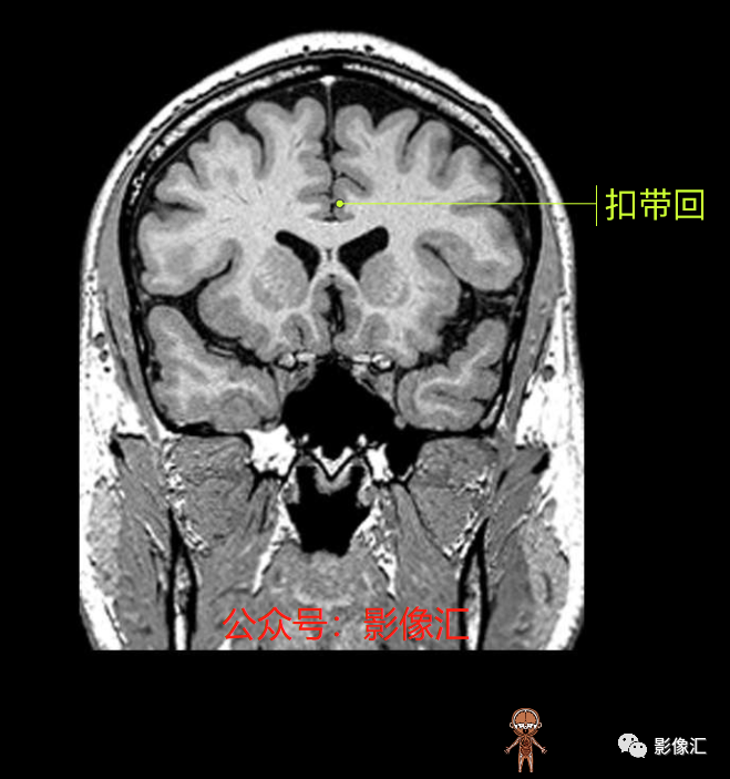 影像PPT - 脑边缘叶MR解剖标记-96