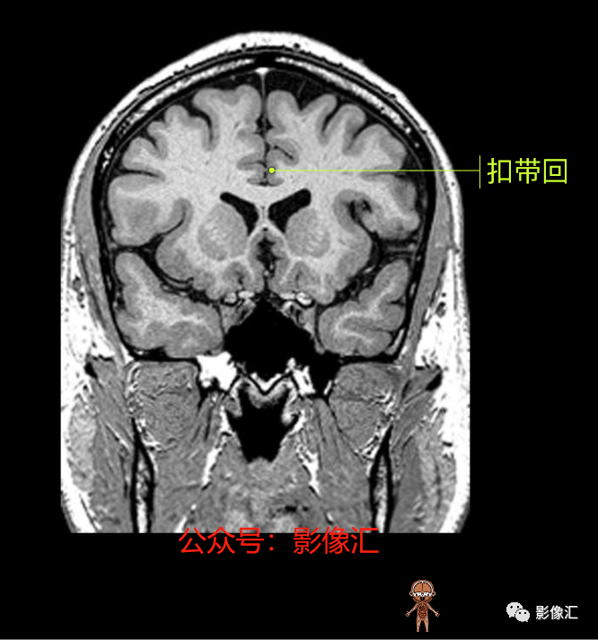影像PPT - 脑边缘叶MR解剖标记-97