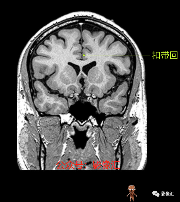影像PPT - 脑边缘叶MR解剖标记-98