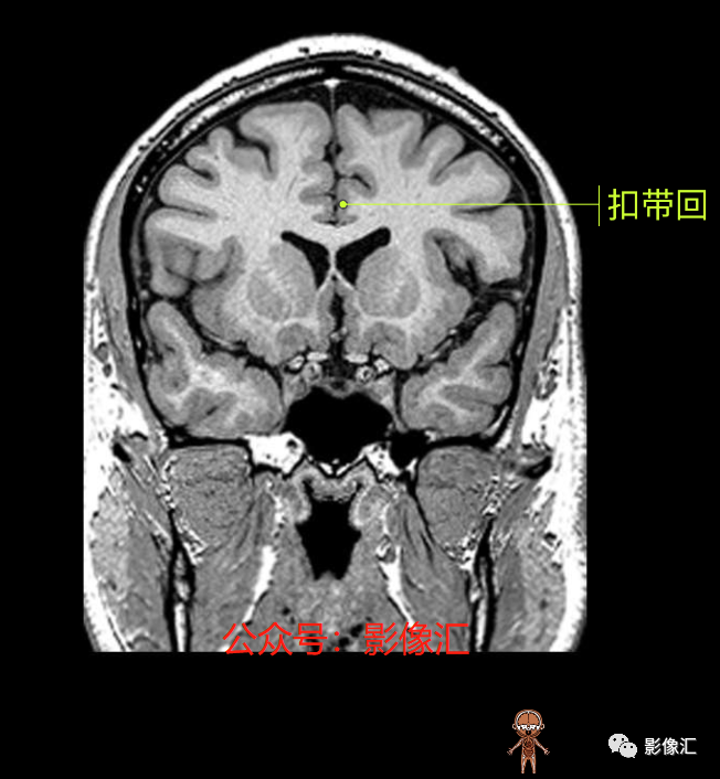 影像PPT - 脑边缘叶MR解剖标记-99