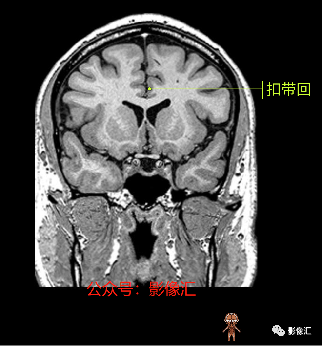 影像PPT - 脑边缘叶MR解剖标记-100