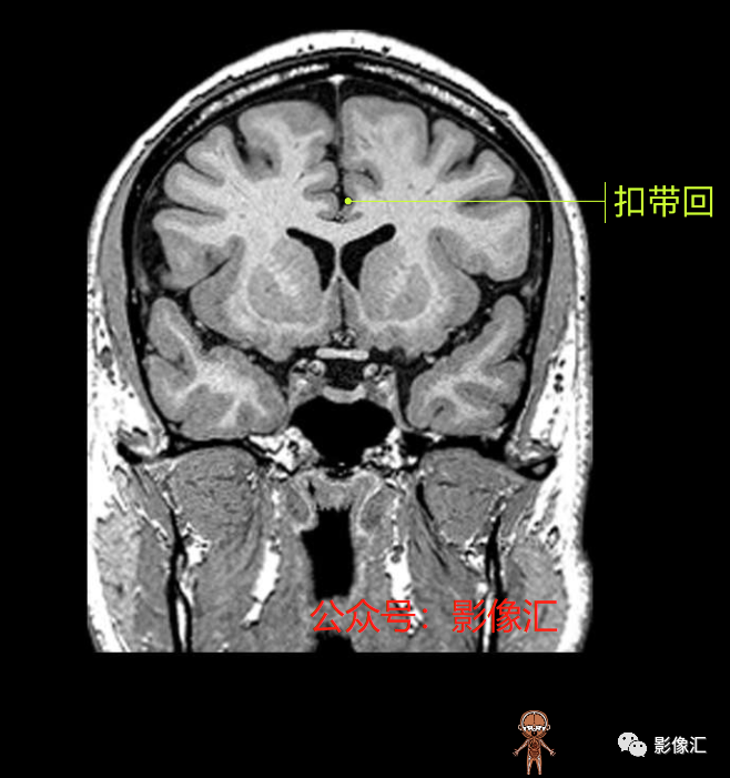 影像PPT - 脑边缘叶MR解剖标记-101