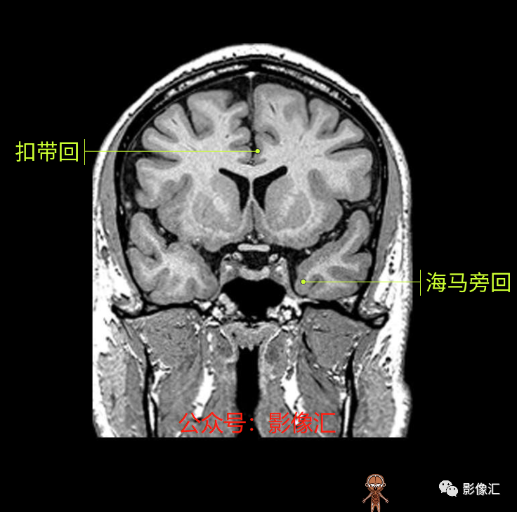 影像PPT - 脑边缘叶MR解剖标记-102