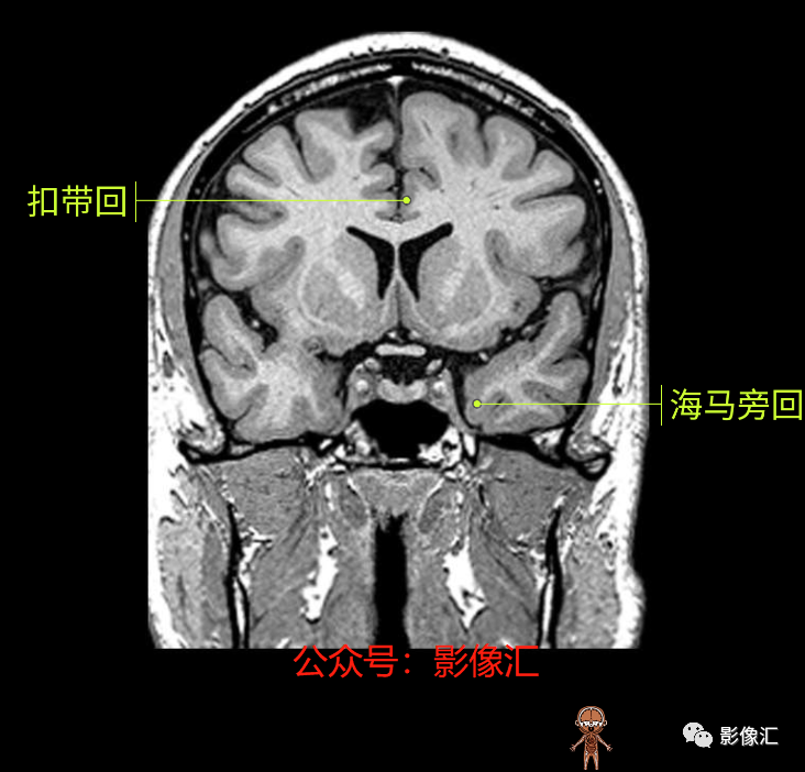 影像PPT - 脑边缘叶MR解剖标记-103