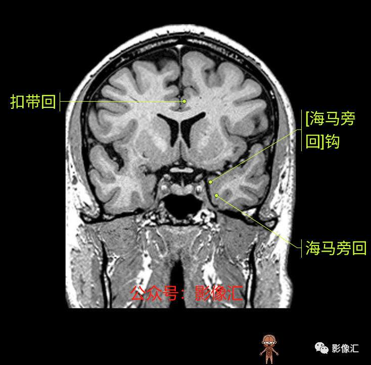 影像PPT - 脑边缘叶MR解剖标记-104