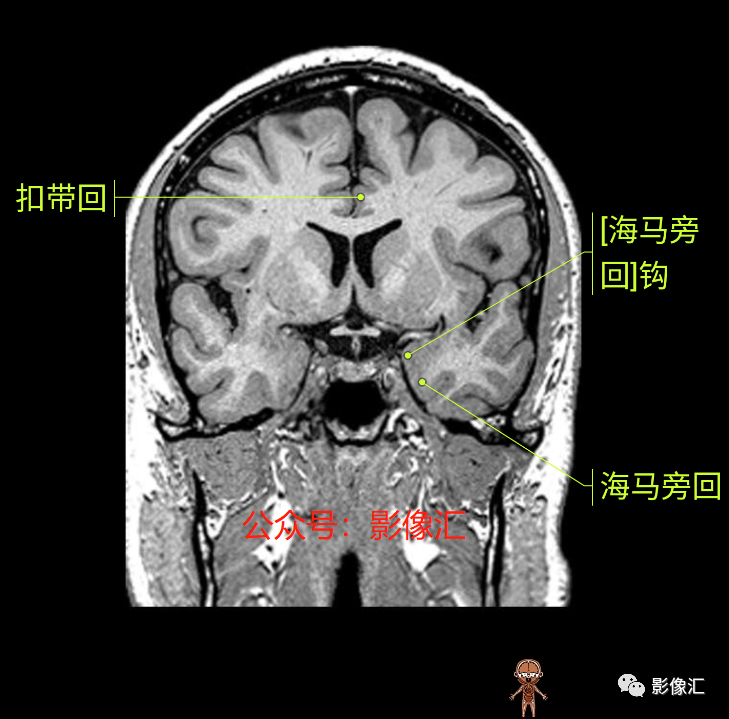 影像PPT - 脑边缘叶MR解剖标记-106