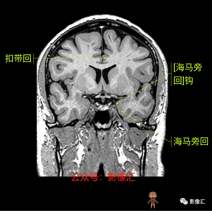 影像PPT - 脑边缘叶MR解剖标记-107