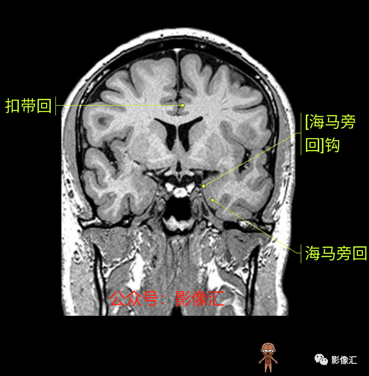 影像PPT - 脑边缘叶MR解剖标记-108