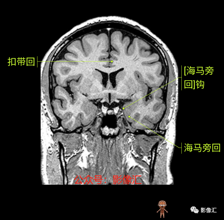 影像PPT - 脑边缘叶MR解剖标记-109