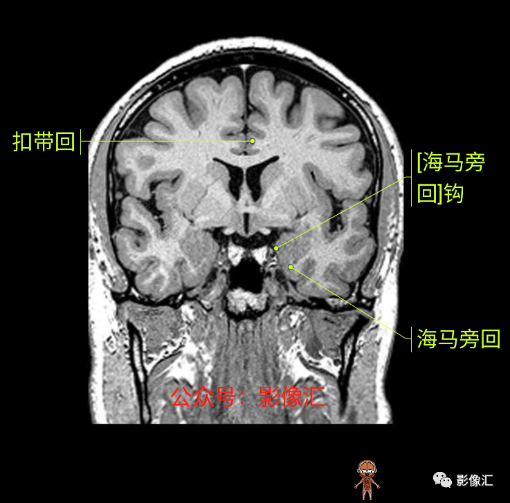 影像PPT - 脑边缘叶MR解剖标记-110