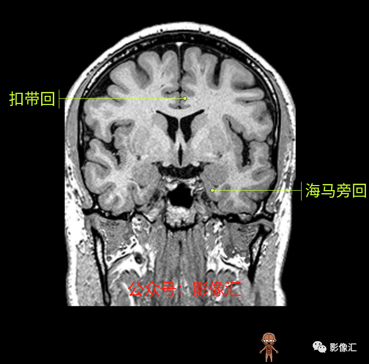 影像PPT - 脑边缘叶MR解剖标记-111