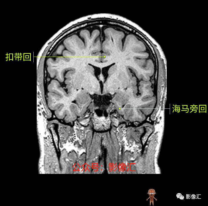 影像PPT - 脑边缘叶MR解剖标记-113