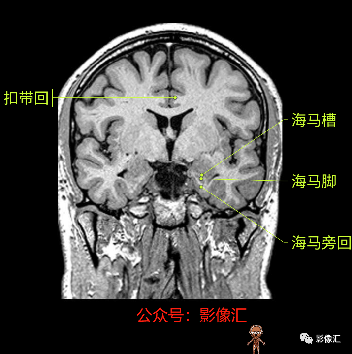 影像PPT - 脑边缘叶MR解剖标记-114