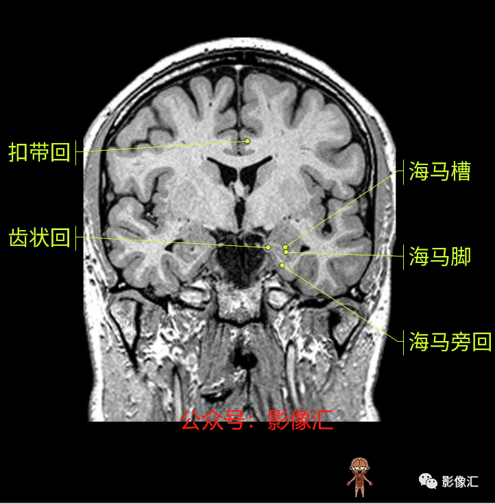 影像PPT - 脑边缘叶MR解剖标记-115