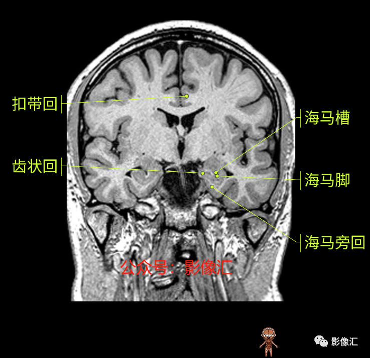 影像PPT - 脑边缘叶MR解剖标记-116