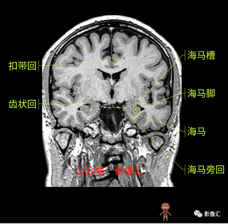 影像PPT - 脑边缘叶MR解剖标记-117
