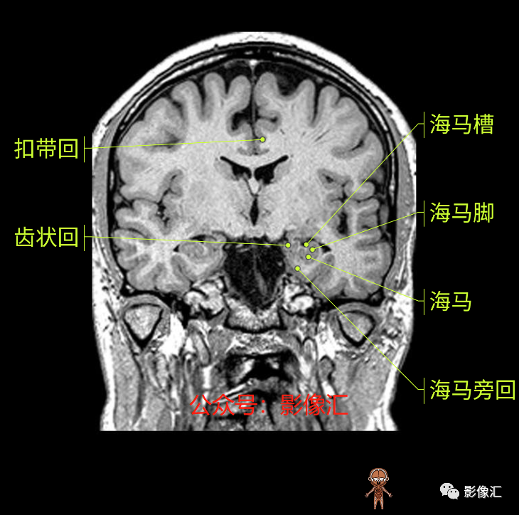 影像PPT - 脑边缘叶MR解剖标记-118