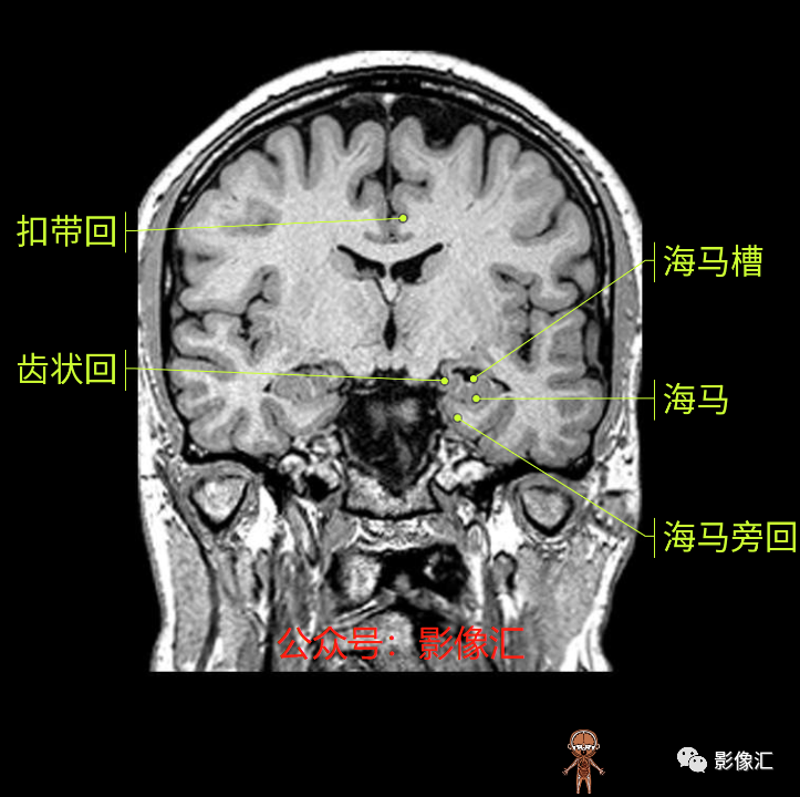 影像PPT - 脑边缘叶MR解剖标记-119