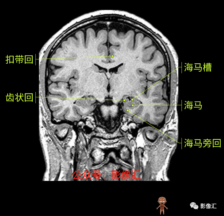 影像PPT - 脑边缘叶MR解剖标记-120