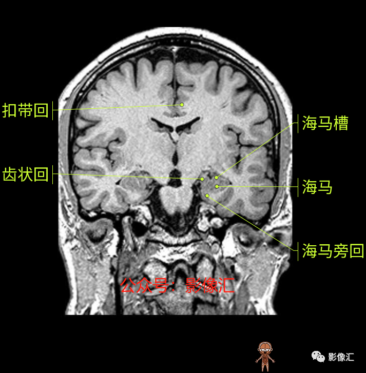 影像PPT - 脑边缘叶MR解剖标记-121