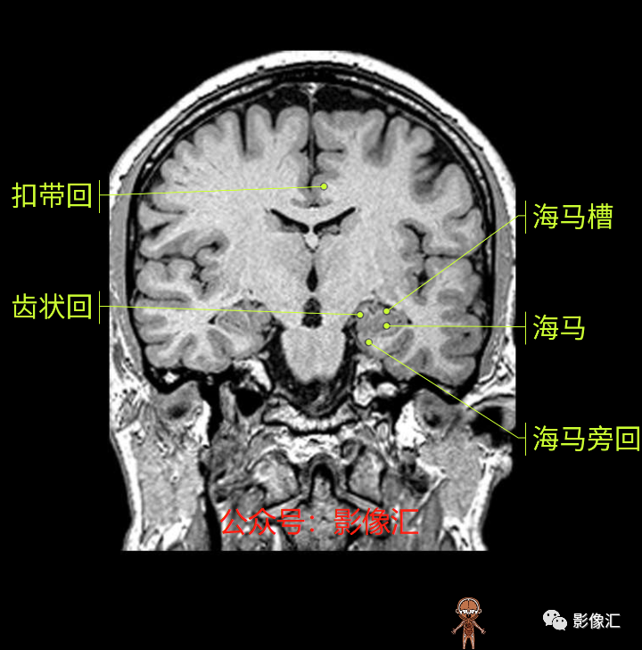 影像PPT - 脑边缘叶MR解剖标记-122