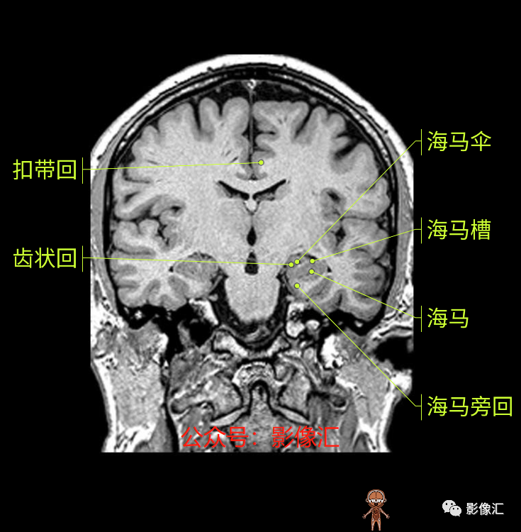影像PPT - 脑边缘叶MR解剖标记-123