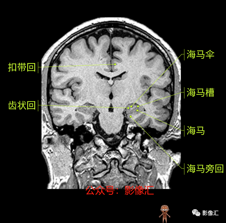 影像PPT - 脑边缘叶MR解剖标记-124