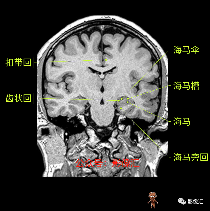 影像PPT - 脑边缘叶MR解剖标记-125