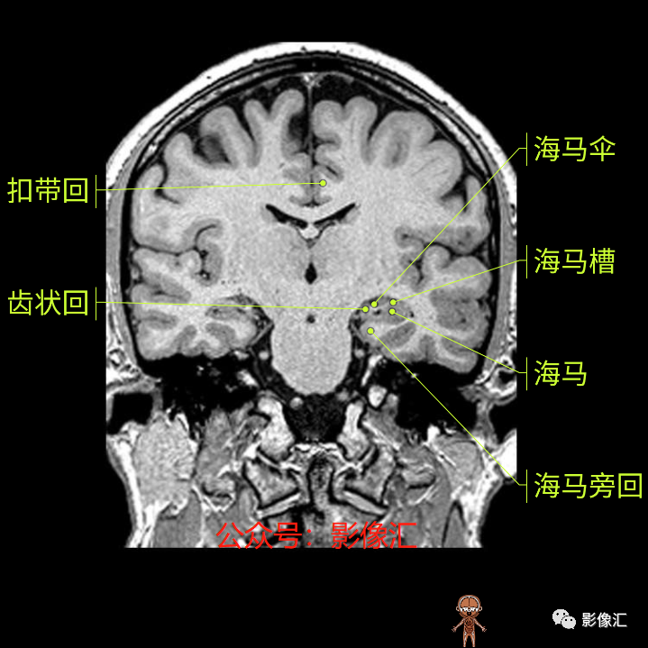 影像PPT - 脑边缘叶MR解剖标记-126