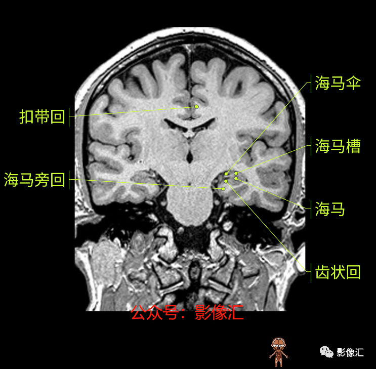 影像PPT - 脑边缘叶MR解剖标记-127