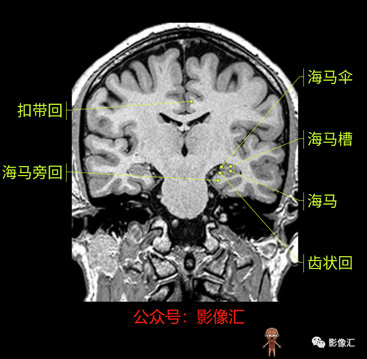 影像PPT - 脑边缘叶MR解剖标记-128