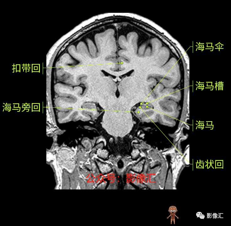 影像PPT - 脑边缘叶MR解剖标记-129