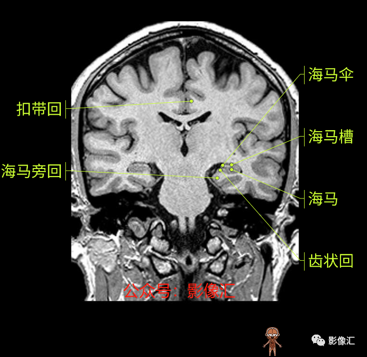 影像PPT - 脑边缘叶MR解剖标记-130