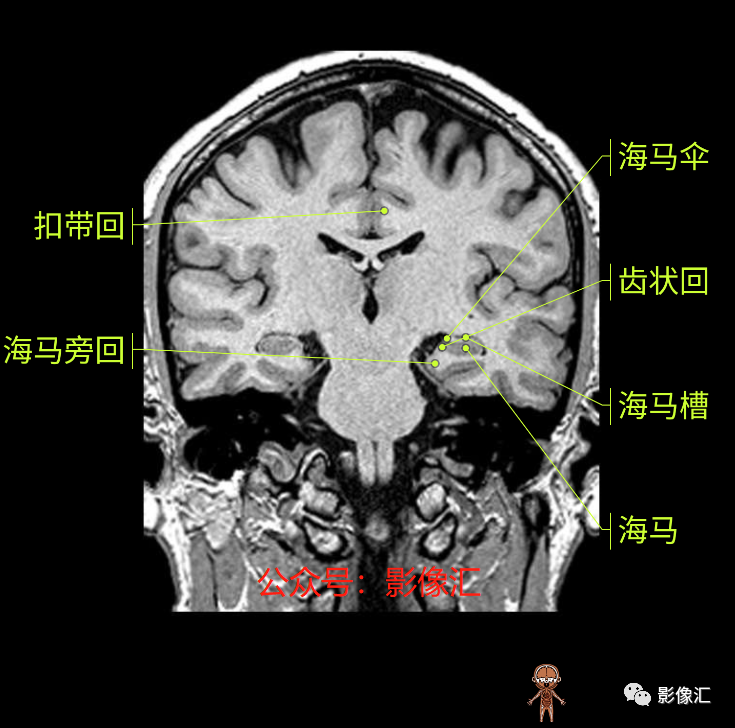 影像PPT - 脑边缘叶MR解剖标记-131