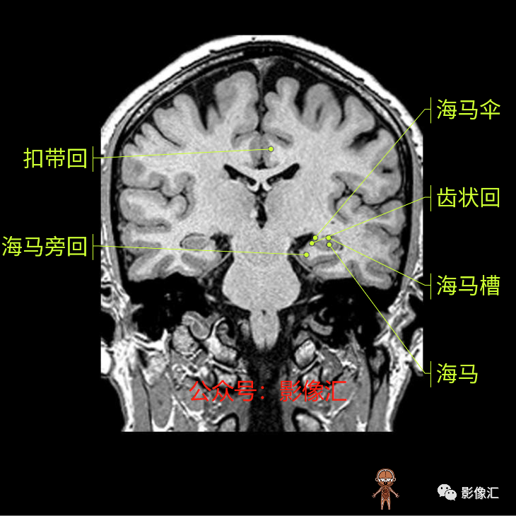 影像PPT - 脑边缘叶MR解剖标记-132