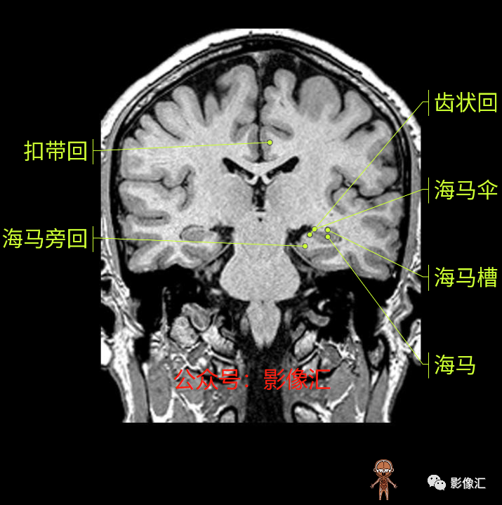 影像PPT - 脑边缘叶MR解剖标记-133