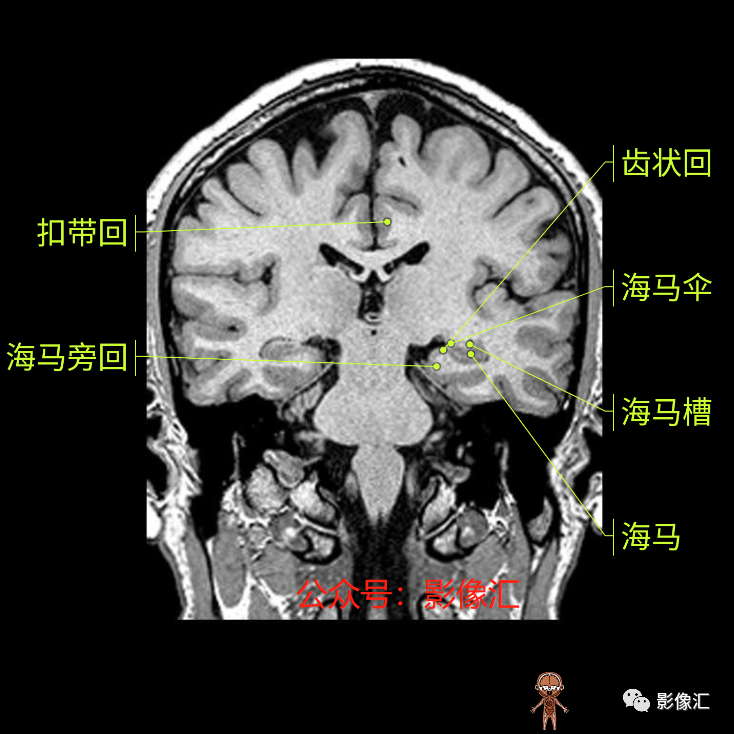 影像PPT - 脑边缘叶MR解剖标记-134