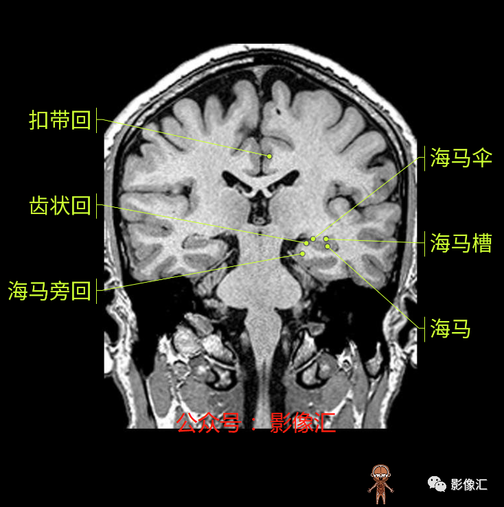 影像PPT - 脑边缘叶MR解剖标记-135
