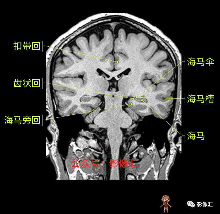 影像PPT - 脑边缘叶MR解剖标记-136
