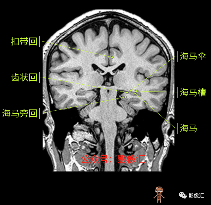 影像PPT - 脑边缘叶MR解剖标记-137