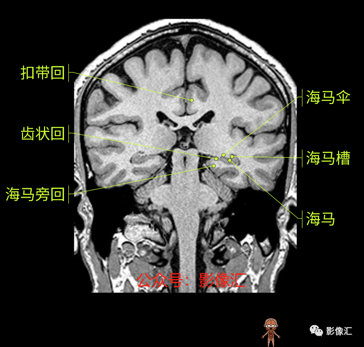 影像PPT - 脑边缘叶MR解剖标记-138